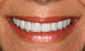 Closeup of woman's teeth after cosmetic dentistry with gaps removed and teeth whitened