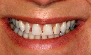 Closeup of woman's teeth showing gaps and discoloration