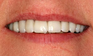 Closeup of woman smiling with even white teeth after cosmetic dentistry