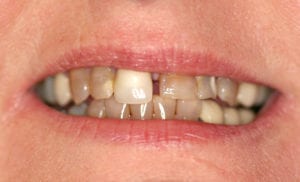 Closeup of woman's severely discolored and uneven teeth.