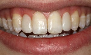 Closeup of woman smiling after application of veneers showing white even smile