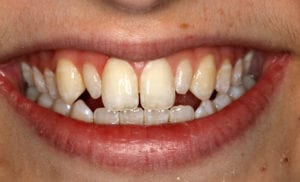 Closeup of woman smiling with uneven discolored teeth