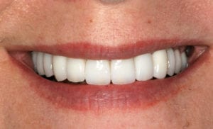 Closeup of woman's mouth showing full smile with incisors filled out