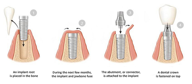 Diagram of dental implant phases and components, including root form placement, osseointegration, abutment, and crown.