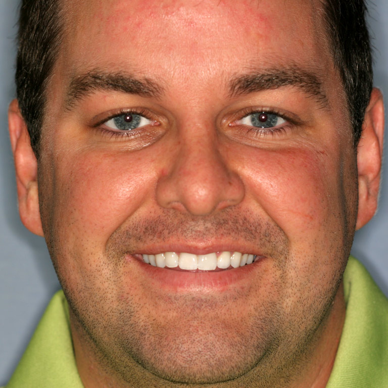 Headshot of man smiling with nice teeth after front tooth repair