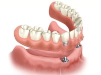 Diagram of a lower implant overdenture. The denture base is hovering over two dental implants that are in the front of the jawbone.