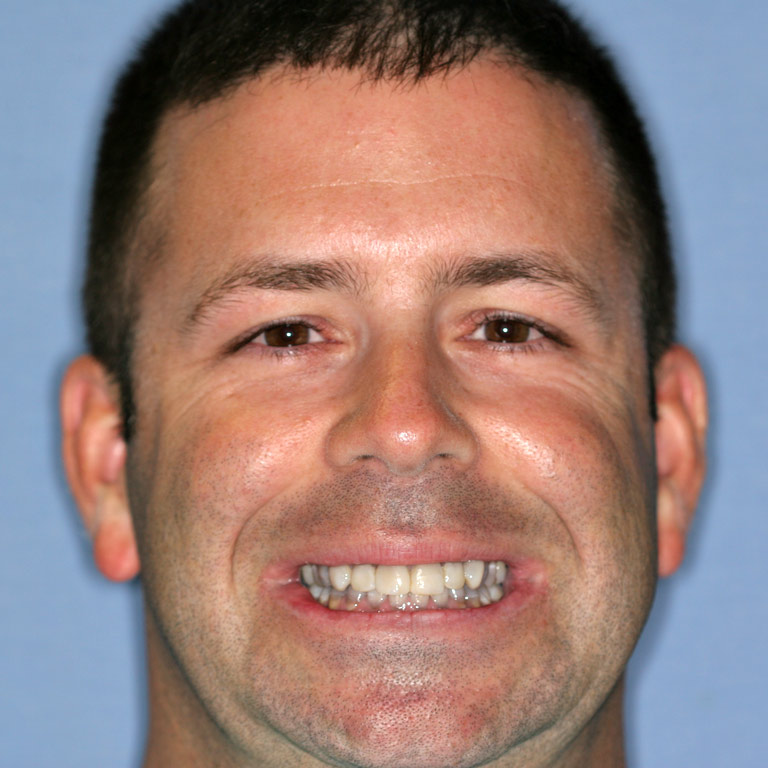 Headshot of dark haired man smiling showing discolored uneven teeth
