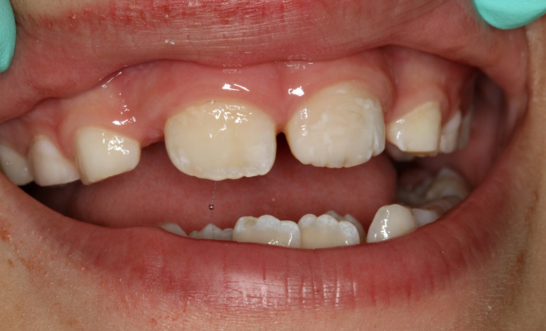 Closeup of child's mouth showing repaired front tooth with no discoloration