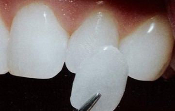 Photo of a porcelain veneer being help up to an incisor tooth.