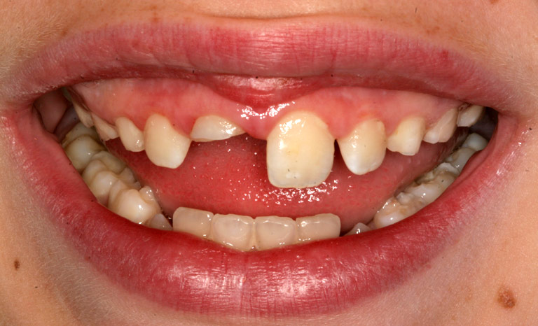 Closeup of child's mouth showing broken front tooth