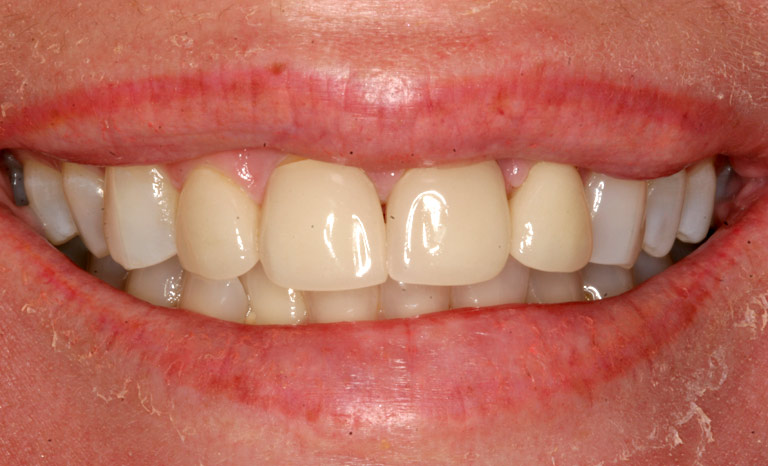 Closeup of woman's mouth showing discolored teeth
