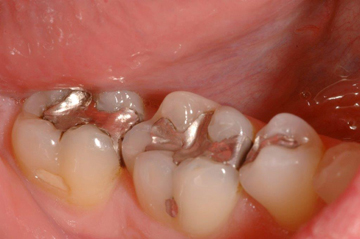 Before mercury-free dentistry photo of three lower molar teeth with amalgam fillings.