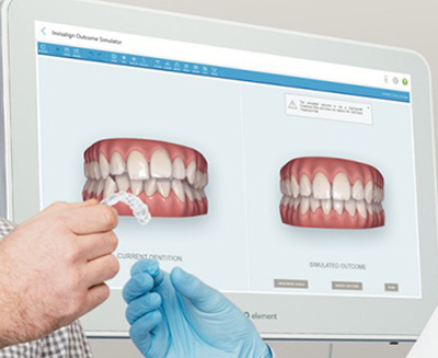 Photo of an iTero monitor displaying teeth models and a patient's hand holding an orthodontic aligner.
