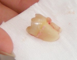 Extracted wisdom tooth on a cloth