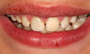 Full-mouth smile after a child's badly broken tooth was repaired by David Finley, DDS of Monroe, LA.