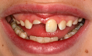 子供のひどく折れた歯がモンローのDDSによって修復される前のフルマウスの微笑。's badly broken tooth was repaired by David Finley, DDS of Monroe, LA.