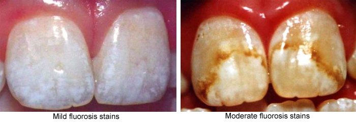 Side-by-side photos of mild fluorosis stains (left) and moderate stains (right)