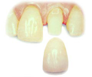 A dental crown in positin to cover a front tooth; for information on Monre, LA dental emergencies