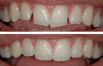Two photographs of upper front teeth. In the top photo, the edges of teeth are jagged. The bottom how enameloplasty (tooth contouring) was used to smooth the edges.