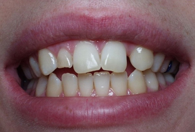 Closeup smile showing one missing upper lateral incisor and a retained primary tooth for the other lateral incisor