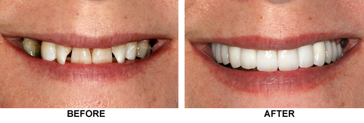 Before and after cosmetic dentistry photos from David Finley, DDS of Monroe, LA