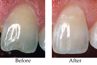 Before and after dental bonding photos
