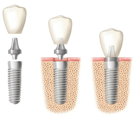 Diagram of three phases of dental implant, including implant components, placement, and completion
