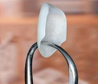 A single porcelain veneer held by dental forceps