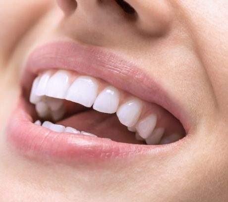White close-up smile portraying what to eat after teeth whitening
