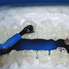 In-office teeth whitening gel being applied to teeth