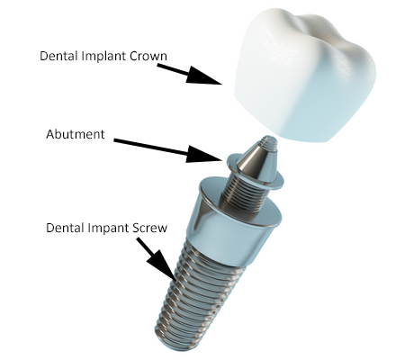 A dental implant with the crown, abutment, and screw labled