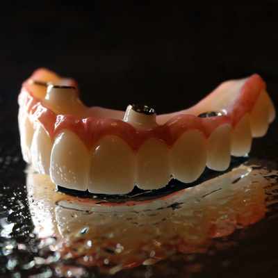 A hybrid upper denture, which is palateless, available from Bayou Dental Group in Monroe