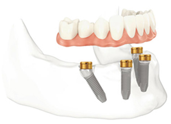 Diagram of a lower denture hovering over four dental implants in the jawbone.