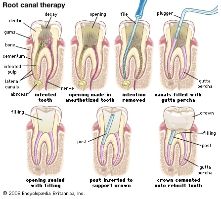 A diagram with seven stages of root canal treatment from accessing the tooth to protecting it with a crown