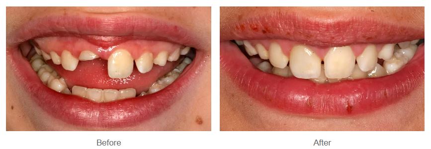 Before and after photos of a child's chipped front tooth