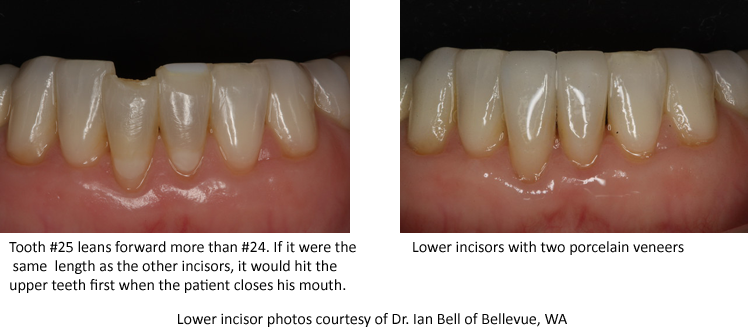 Before and after photos of a lower chipped incisors with dental bonding replaced with porcelain veneers