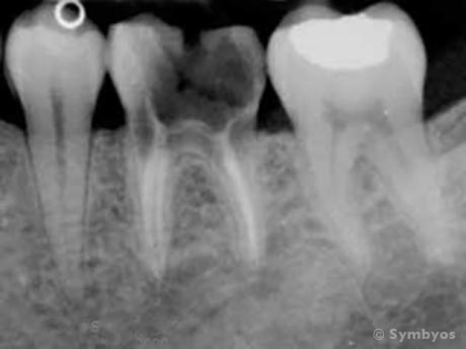 X-ray of an unrestorable tooth
