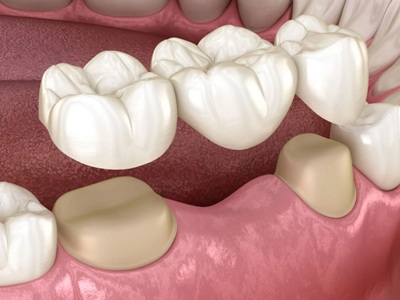 A dental bridge hovered over prepared teeth and the space of a missing tooth