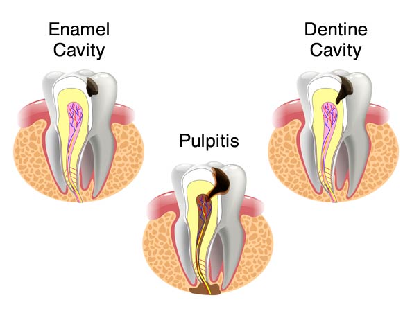 Diagram of tooth cavity progression