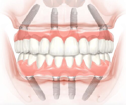 Diagram of upper and lower all-on-4 dental implants with implant screws n the jawbone