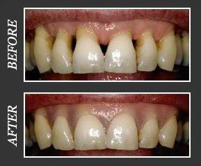 Before and after gingival mask used to hid black triangles between teeth