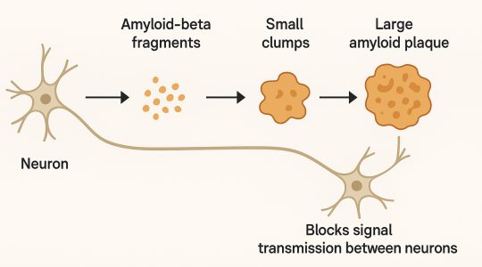 A diagram illustrating how amyloid plaques can impair brain function in Alzheimer’s disease
