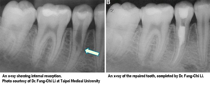 Before and after internal resorption repair of a lower tooth.