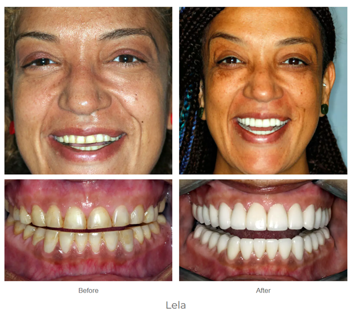 Before and after dental crown photos from Dr. Finley of Monroe, LA