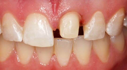 A shaved-down front tooth for crown preparation
